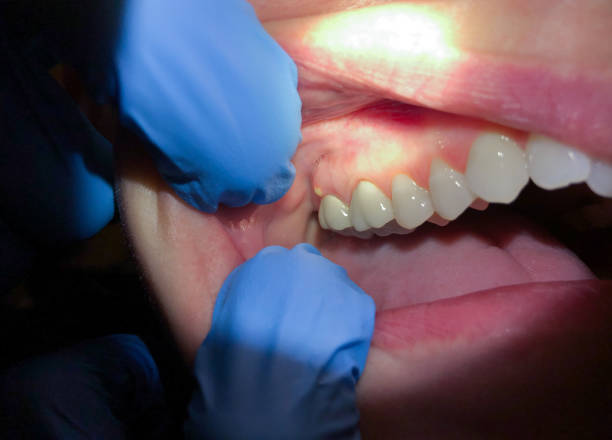 Best Broken or Chipped Tooth Repair in Rochelle, IL