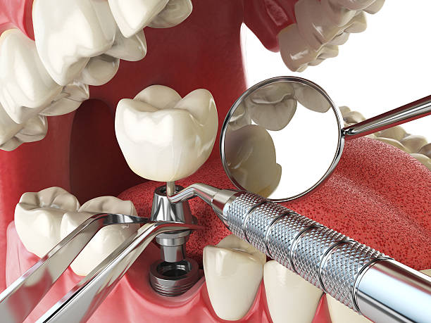 Best Emergency Root Canal Therapy in Rochelle, IL